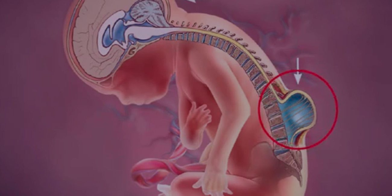 Cuando la clínica habla por la médula: Reconociendo la médula anclada en urología pediátrica